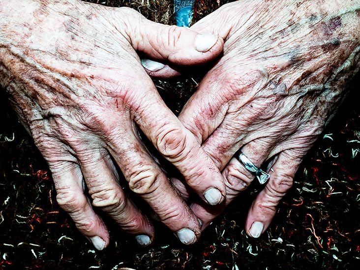 Skin swabs may help detect Parkinson’s years before symptoms appear