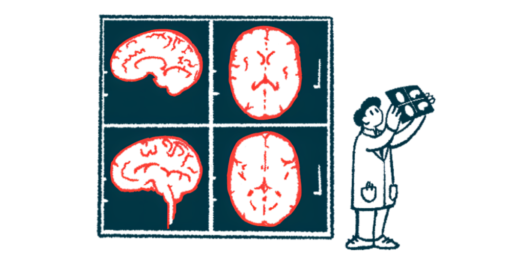 A researcher holds up an image of a brain scan that